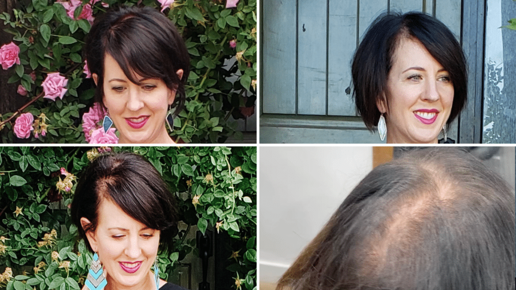 Hair loss pictures